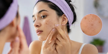 Over Exfoliation Pigmentation