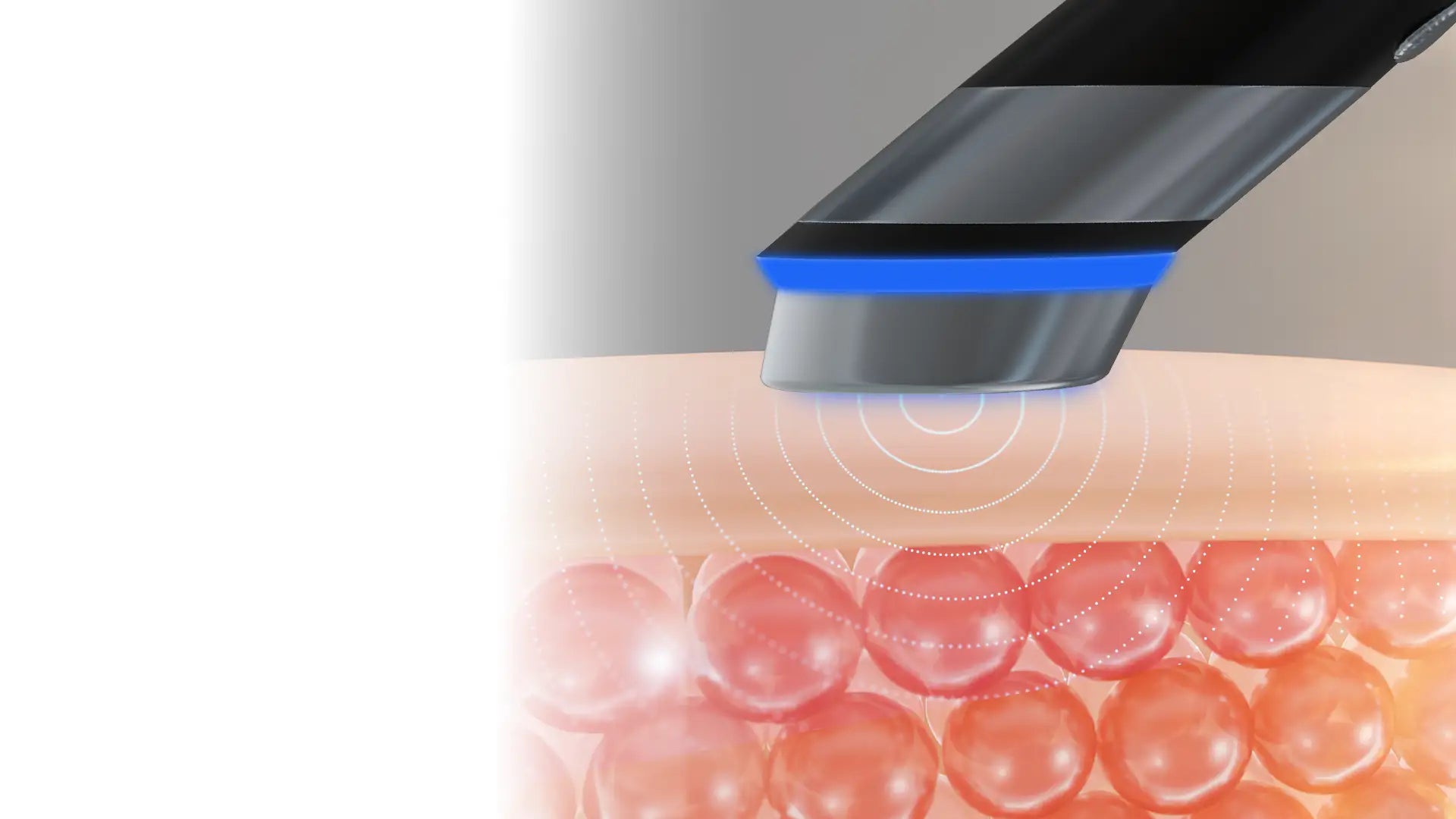 Needle Free Glow Poration Technology